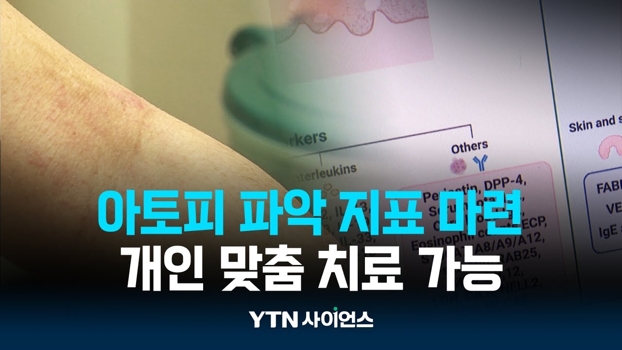 아토피 파악 지표 첫 집대성...개인 맞춤 치료 가능