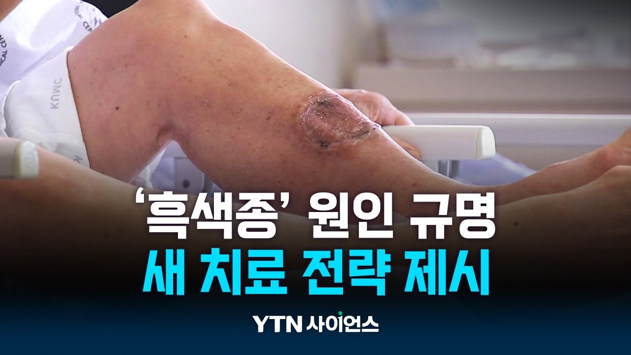 항암제 잘 안 듣는 '흑색종' 원인 규명…새 치료법 제시