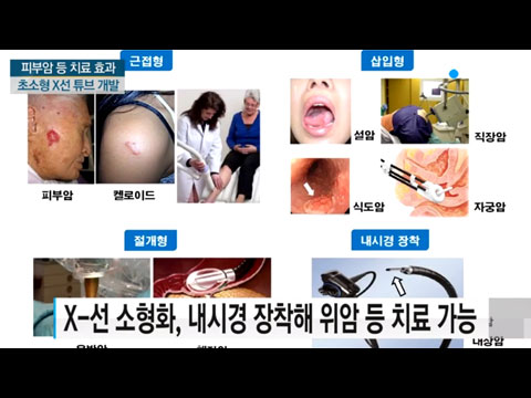 [사이언스TV] 피부암 등 치료 효과 X-선 초소형 튜브 개발