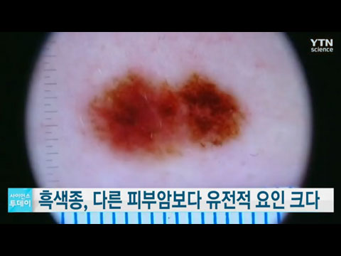 [사이언스TV] 흑색종, 다른 피부암보다도 유전적 요인 크다