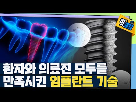 [핫클립] 특별한 기술력의 임플란트