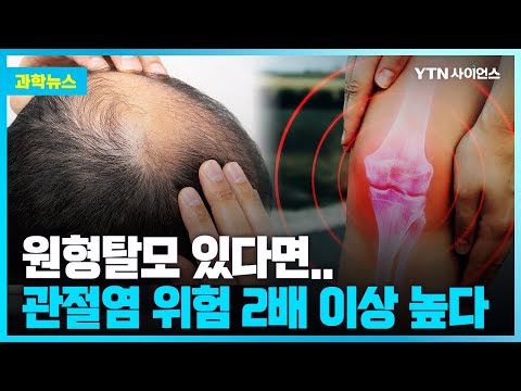 [과학뉴스] 원형 탈모.. 건선, 관절염 위험 증가와 관련